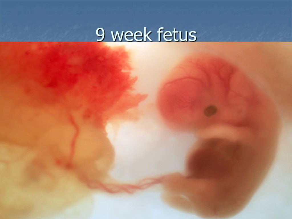9 week fetus